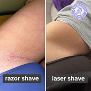 Laser Hair Removal Kit: For Smooth Skin